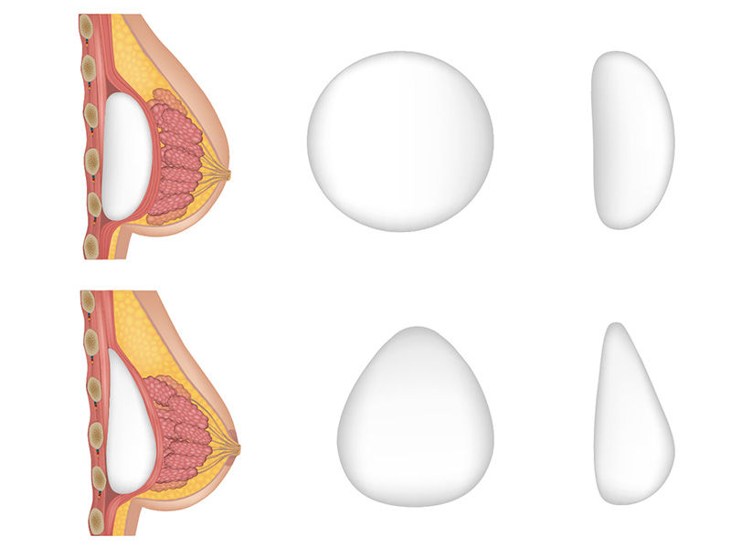 Arten von Brustimplantaten