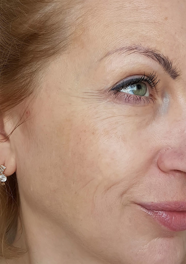 Vorher Bild einer Botox Behandlung