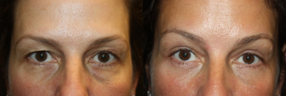 Augenlidstraffung - FineSkin - Ästhetische Chirurgie - Augenlidstraffung - Brustvergrösserung – Fettabsaugung - 3D Simulation (Beratung) - Ästhetische Dermatologie - Hyaluron - Muskelrelaxans - Fettwegspritze - Fadenlifting - PRP Vampire Lifting - TCA-Peeling - Medizinische Kosmetik (Gesicht) - Observer-Hautanalyse - HydraFacial - Mesotherapie - QuadroStar - Secret RF Microneedling - Diodenlaser MeDioStar - IS Clinical Fire & Ice - Chemische Peelings - Fruchtsäurepeeling -ICOONE Laser - Seyo TDA Beautysystem -Ultraschallbehandlung - BB Glow Microneedling - Klassiche Gesichtsbehandlung - Medizinische Kosmetik (Körper) - Kryolipolyse - ICOONE Laser Body - Secret RF Microneedling Body - Dauerhafte Haarentfernung - VIP Line Elektrotherapie Body - Methode Brigitte Kettner - iS Clinical - Aesthetico - IMAGE Skincare - Beauty Secrets