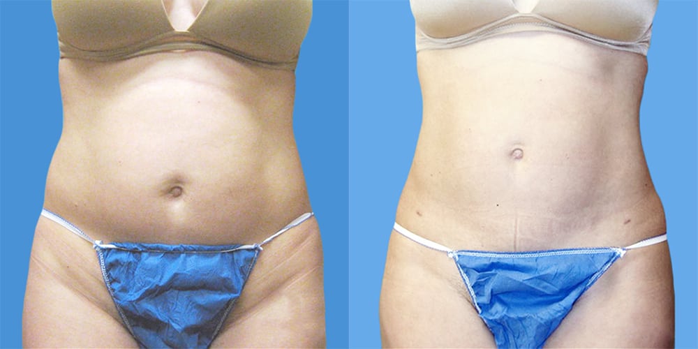 Vorher / Nachher Bild einer Fettabsaugung am Bauch - FineSkin - Ästhetische Chirurgie - Augenlidstraffung - Brustvergrösserung – Fettabsaugung - 3D Simulation (Beratung) - Ästhetische Dermatologie - Hyaluron - Muskelrelaxans - Fettwegspritze - Fadenlifting - PRP Vampire Lifting - TCA-Peeling - Medizinische Kosmetik (Gesicht) - Observer-Hautanalyse - HydraFacial - Mesotherapie - QuadroStar - Secret RF Microneedling - Diodenlaser MeDioStar - IS Clinical Fire & Ice - Chemische Peelings - Fruchtsäurepeeling -ICOONE Laser - Seyo TDA Beautysystem -Ultraschallbehandlung - BB Glow Microneedling - Klassiche Gesichtsbehandlung - Medizinische Kosmetik (Körper) - Kryolipolyse - ICOONE Laser Body - Secret RF Microneedling Body - Dauerhafte Haarentfernung - VIP Line Elektrotherapie Body - Methode Brigitte Kettner - iS Clinical - Aesthetico - IMAGE Skincare - Beauty Secrets