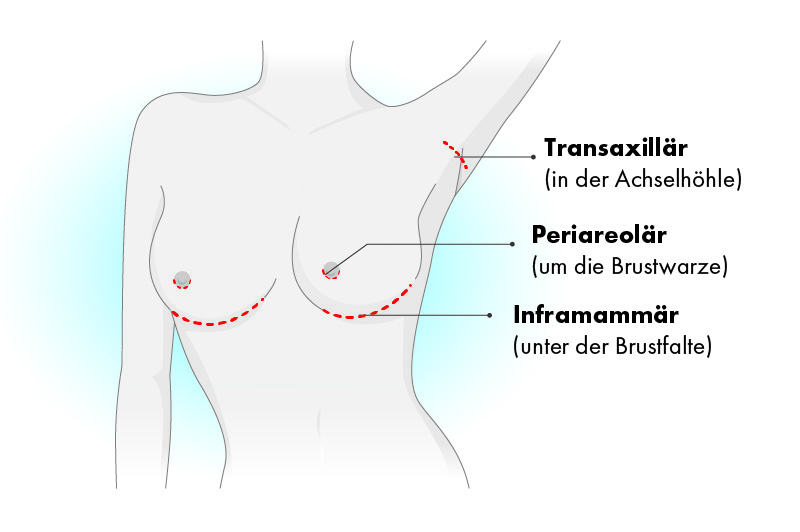 Chirurgische Zugangswege für Implantate