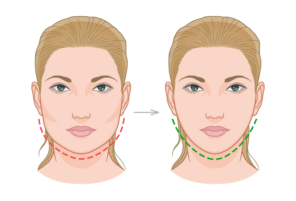 Ein schmaleres Gesicht durch eine Masseter Behandlung mit Botox